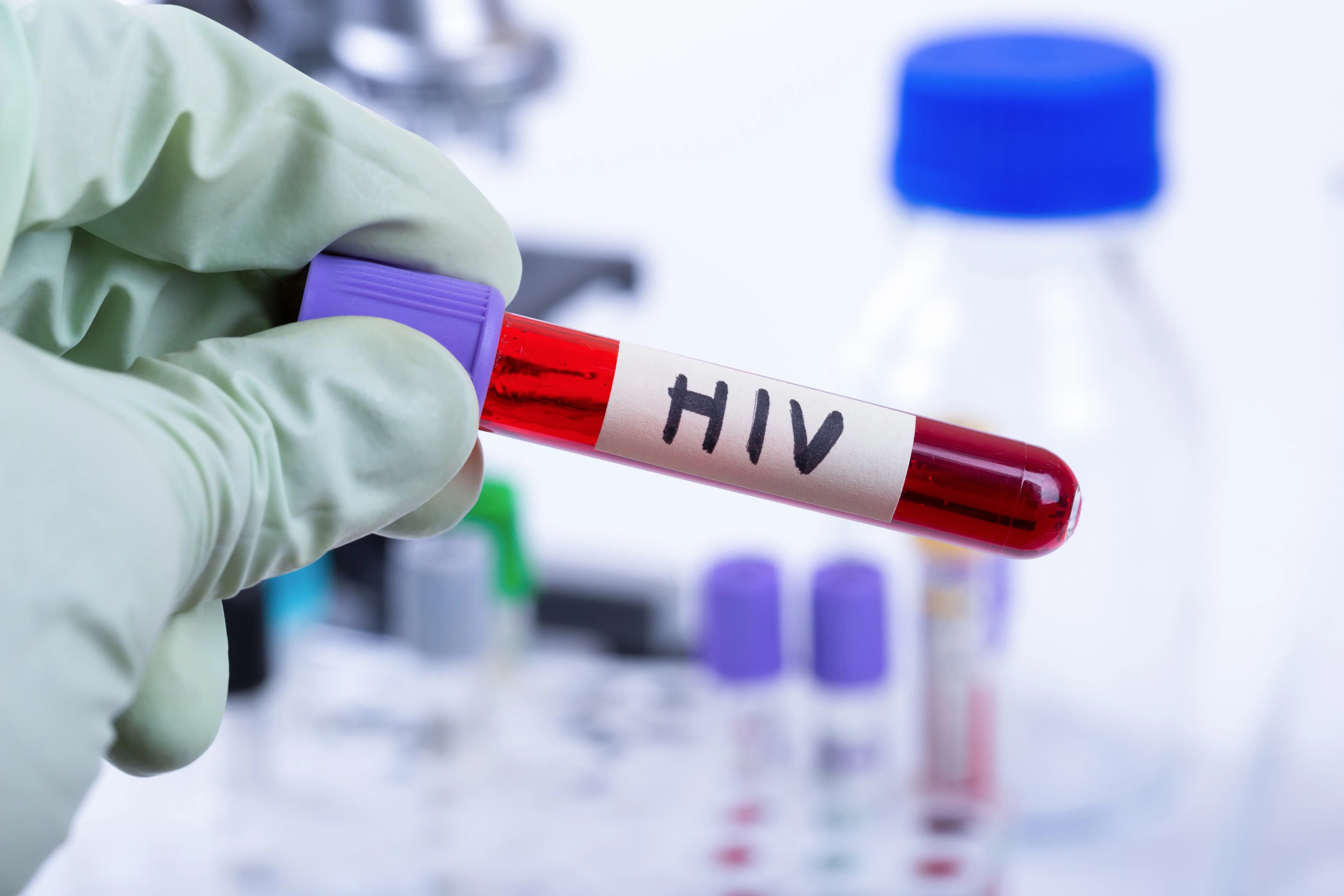 6 anos sem sinais do HIV após transplante; mutação rara não foi decisiva